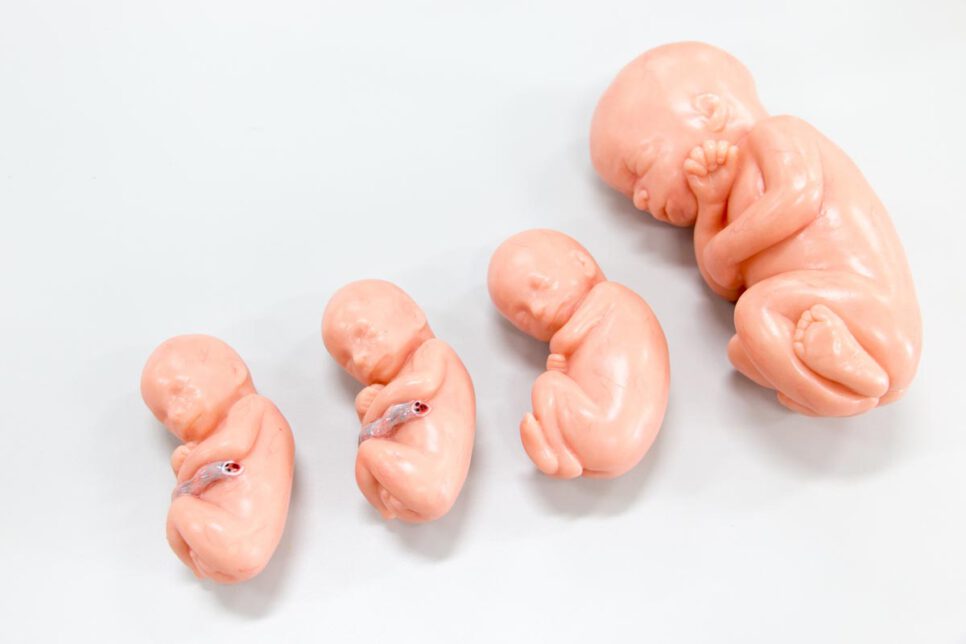 Muerte Fetal Anteparto